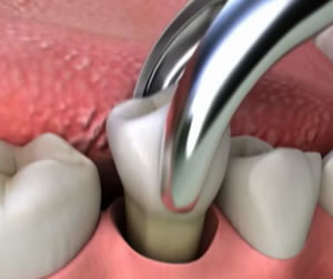 Tooth Extractions